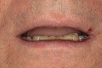 Figure 6 With lips in repose, less than 1 mm of the central incisors were visible.