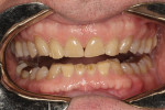 Figure 4 Upper and lower arch appearance in 2004 (Fig 4) compared to 2014 (Fig 5). Note the similar appearance in the wear and chipping of teeth 10 years later.