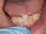 Figure 10 Direct bonding was placed on a lower incisor at the appropriate length and size.