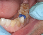 Figure 12 Direct placement of composite to create the new occlusal vertical dimension.