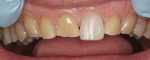 Figure 8 Direct composite was placed one tooth at a time at the new incisal and facial position.