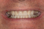 Figure 14 Direct composite placed and polished on teeth Nos. 20 through 29.