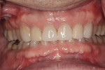 Figure 9 Completed direct composite bonded restorations for teeth Nos. 6 through 11.