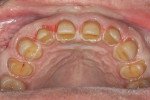 Figure 17 Maxillary preparations with cingulums intact and adequate enamel for bond strength.
