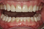 Figure 20 Completed restorations showing the even occlusal plane.