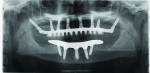 Figure 6 Panoramic radiograph following delivery of definitive prostheses.