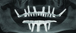 Figure 8 Panoramic radiograph at follow-up visit, 7 years following initial implant treatment.