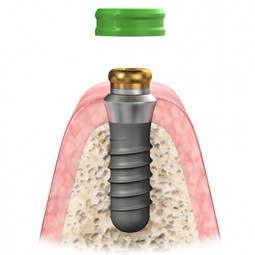SternSnap Overdenture Implant Abutment System by Sterngold Dental, LLC