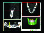 Fig 5. Implant placement was planned in the context of the proposed full-arch digital denture.