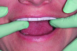 Fig 9. The tray was gently seated all the way in the patient’s mouth and held firmly in place.