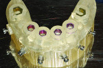 Fig 7. The implant surgical guide
would facilitate placement of the four mandibular implants to support the retrofitted digital denture.