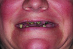 Close-up preoperative view of the patient’s smile.
