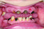 Close-up retracted view of the patient’s maxillary and mandibular arches illustrates the extent of visible dental disease.