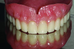 View of the highly esthetic finalized digital denture (Pala Digital Denture).