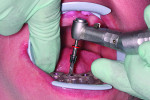 Implant placement was performed using a surgical guide.