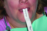 The patient’s lip length was measured.