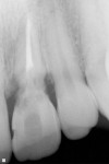 Figure 2 Preoperative digital radiograph of tooth #9.