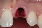 Figure 3 Tooth #9 was atraumatically extracted.