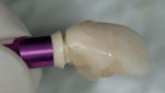 Figure 6 The natural tooth shell was retrofitted to the provisional abutment.