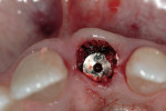Figure 9 Flapless bone grafting corrected the osseous defect.