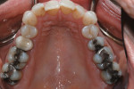 Figure 3 Several locations of recurring caries, as well as failed restorations, were evident.