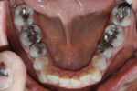 Figure 4 Several locations of recurring caries, as well as failed restorations, were evident.