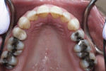 Figure 8 Maxillary occlusal view after completed orthodontic treatment.
