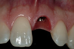 Figure 12 The emergence profile has formed at 1 month post-implant placement.