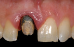 Figure 2 Once the existing crown was removed, the excessive apical placement of the preparation’s margin was apparent.