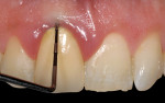 Figure 1 Crown margin has impinged upon connective tissue attachment. A periodontal probe was used for bone sounding the alveolar crest, which was 1 mm. The facial free gingival margin had the potential to move coronally by a process known as “creeping reattachment.”