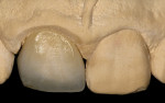 Figure 8 The gingival margin of the completed crown preparation followed the soft-tissue outline. The convexity of the facial margin
of the definitive ceramic crown established the position and contour of the free gingival margin.