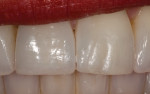 Figure 13 Patient’s smile at 1-year follow-up.