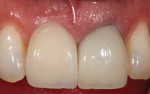 Figure 17 The initial appearance of the
patient’s maxillary right implantsupported
and left natural tooth crowns. Note the deficiencies of the restorative contour and soft-tissue profile.