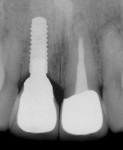 Figure 20 Radiograph taken at time of definitive
crown placement.