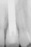 Figure 17 Digital periapical radiograph of the completed case.