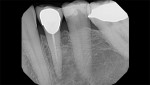 A periapical radiolucency associated with tooth No. 21, which had inadequate root canal therapy with an adequately sealing crown 3 years previously.