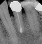 The 6-year recall radiograph shows that the tooth is still functioning and lacking any pathology.