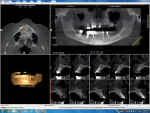 Preoperative CBCT for determination of the potential positioning of dental implants and evaluation of the significant anatomy, including maxillary sinus as well as available horizontal and vertical bone.