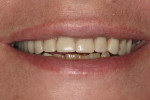 Immediate complete denture was fabricated to be seated immediately following extraction of the remaining maxillary teeth.