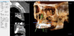 Computed tomography diagnosis was completed and ideal positioning of the six implants was done virtually prior to any surgical intervention. From this diagnosis, a surgical guide was created to help in the proper placement of the dental implants.