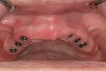 The healing abutments placed allowed the tissue to heal properly with attached gingiva on the facial aspects.