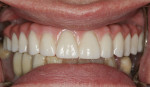 Retracted view of one-piece BruxZir bridge illustrating tooth contours and gingival shading.