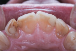 Exposed dentin, as seen in this patient’s incisors, is not normal.