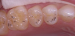 Numerous examples of incline interferences exist here, including the large “hit and slide” evident on tooth No 5.