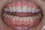 Another example of a horizontal wear patient. Anterior treatment was completed, yet failures and wear of the posterior teeth still occurred.