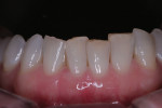 Note the wear on the mandibular teeth in this constricted vertical wear pattern patient.