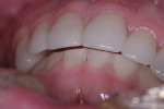 The patient in Figure 9 was restored with an anterior open bite in the patient habitual occlusion.