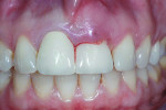 Fig 1. View of the patient’s preoperative dentition in situ.