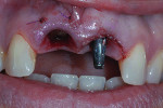 Fig 5. Tooth No. 8 was extracted and the implant was placed.