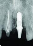 Fig 3 and Fig 4. Figure 3 features preoperative radiograph of tooth No. 9, showing the implant and crown. Figure 4 depicts the soft tissue regeneration.